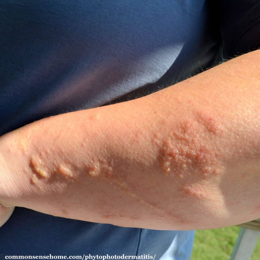 stages of poison ivy rash